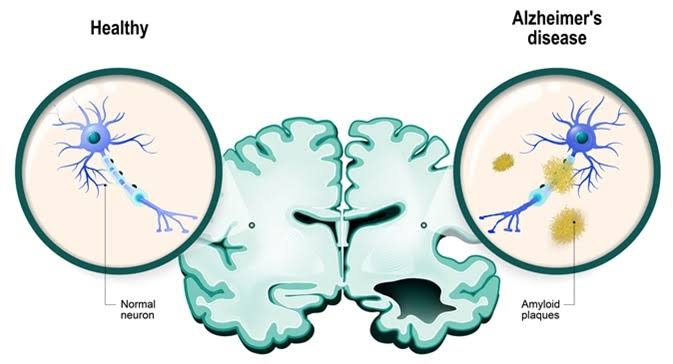 Alzheimer disease and types