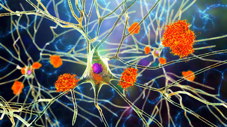 Alzheimer’s drug