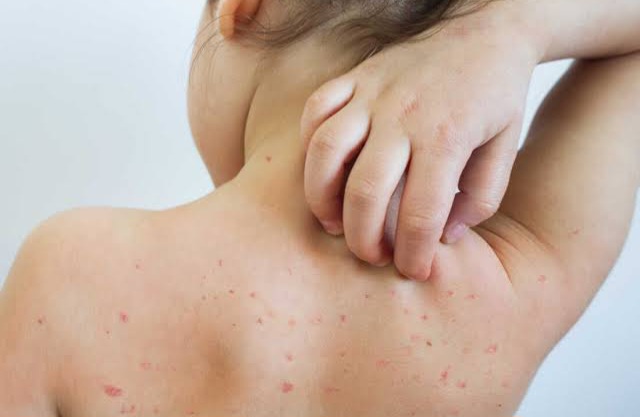 Measles
