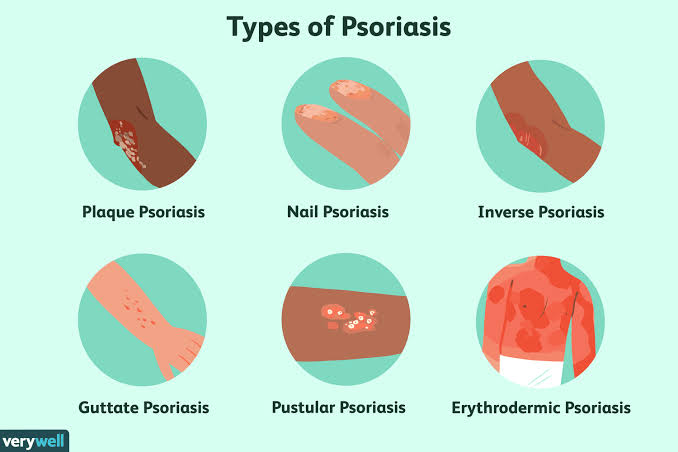 Psoriasis