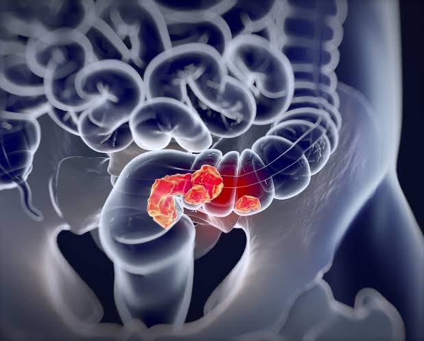 Colorectal Cancer Risk