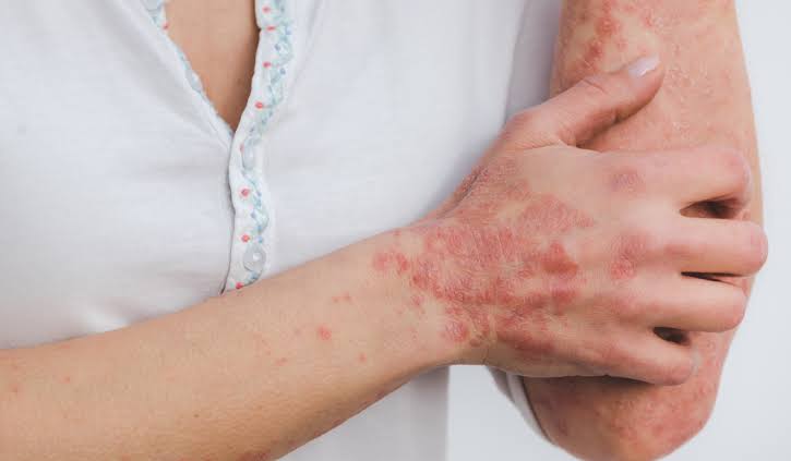 Psoriasis
